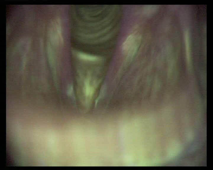 Рис.4 Видеоэндоскопия и аутофлюоресцентная эндоскопия гортани пациента с раком левой голосовой складки   T1N0Mx (рак in situ левой голосовой складки) (AF-)