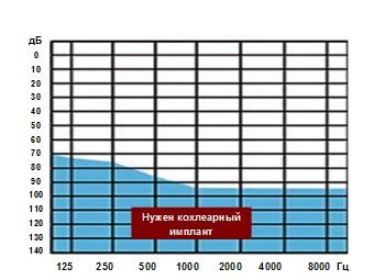 Рисунок 1. Зона аудиограмм, при которой пациенту рекомендуется кохлеарная имплантация